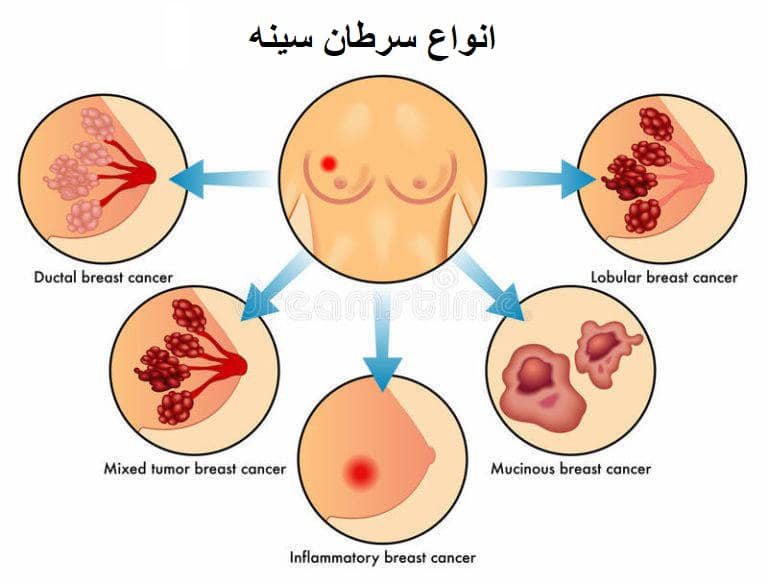 علائم سرطان سینه در زنان چیست؟